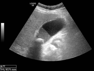 Cholecystitis. Calculous cholecystitis with a thickened gallbladder wall, large gallstone in the neck, sludge in the gallbladder. 