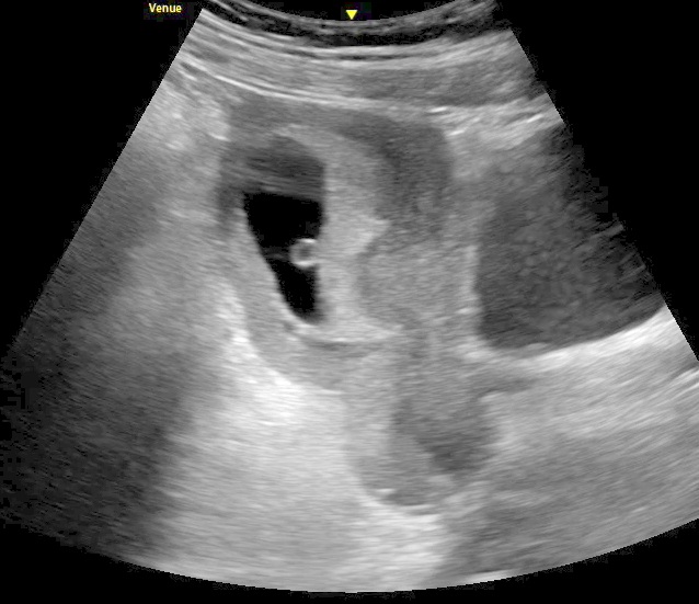 This image demonstrates an intrauterine pregnancy with a yolk sac. On the right of the ultrasound image is a distended bladder.
