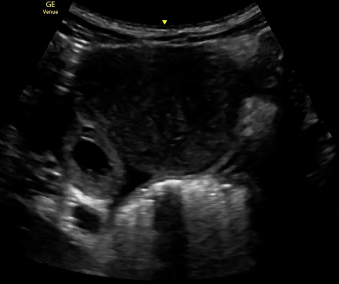 This image demonstrates an ectopic pregnancy via ultrasound.