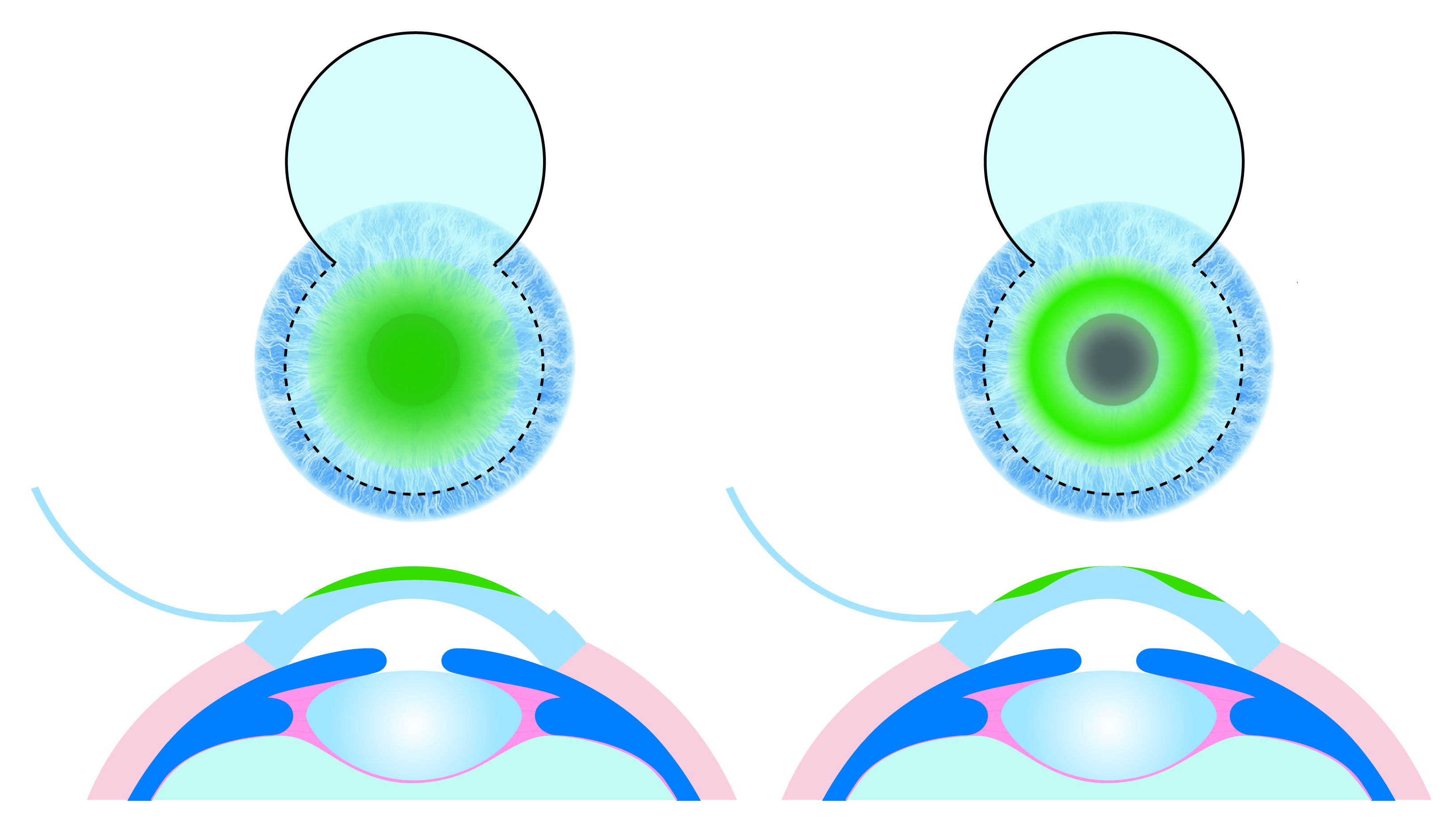 Figure 1. LASIK correction of myopia (left) flattens the central corneal surface, thus correcting the focal plane on the retina. LASIK correction of hyperopia (right) sculpts the cornea to make a steeper central area, thus correcting the focal plane on the retina.