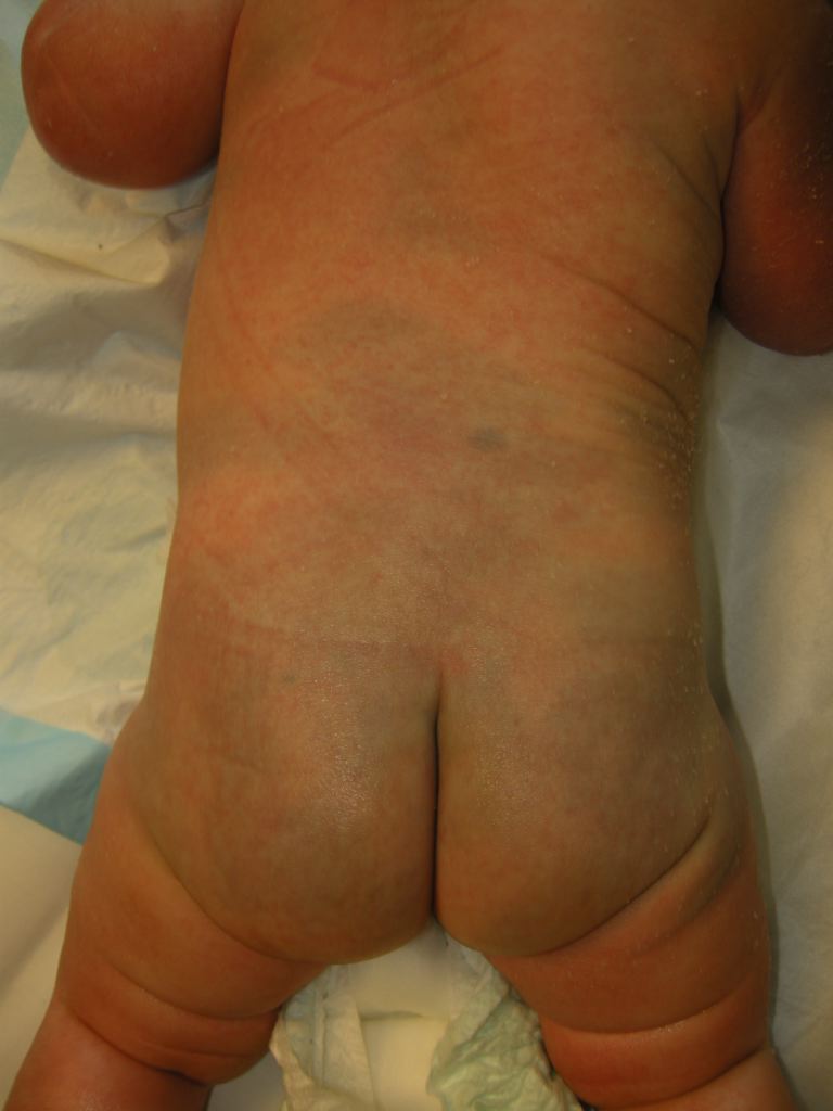 Congenital Dermal Melanocytosis (Mongolian Spot)