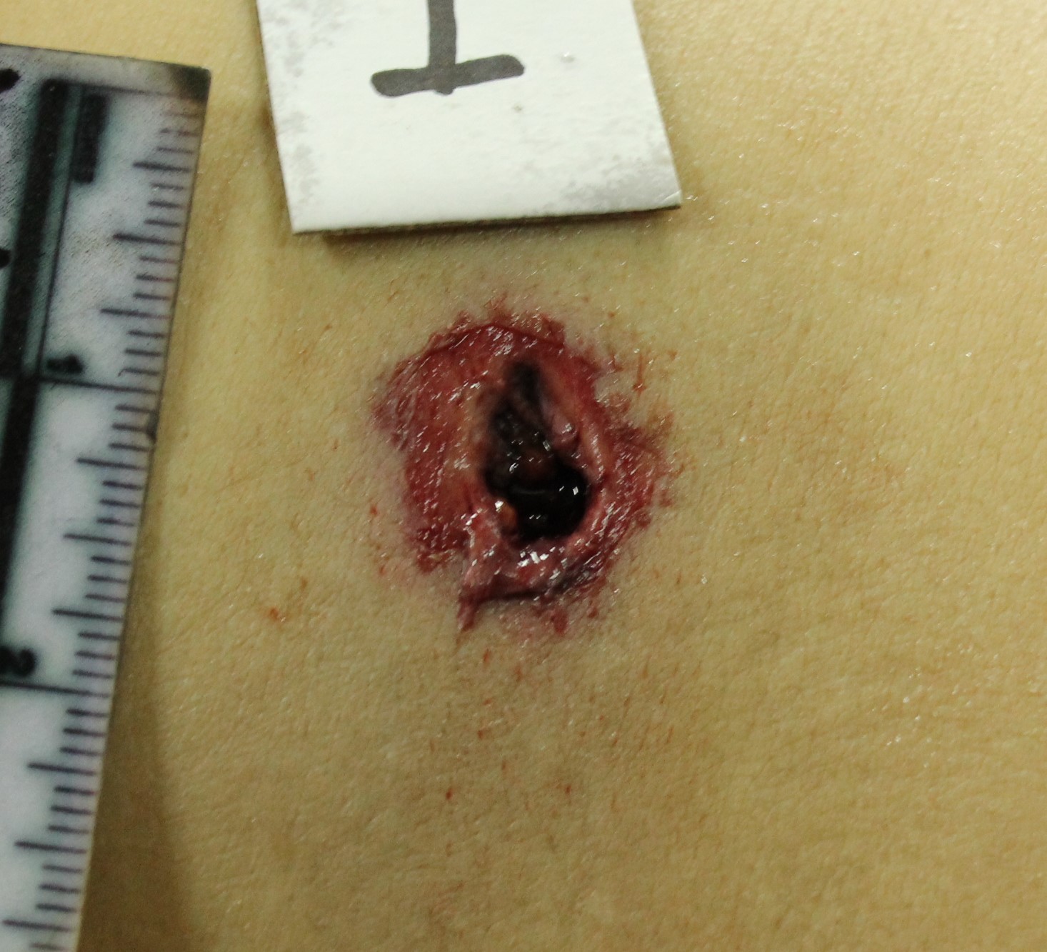 Figure 2 - Exit wound from a rifled small arm (revolver) showing larger injury, in comparison with the entry wound. Also, the injury is irregular in shape, with outward beveling of the margin.