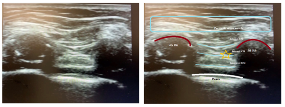 Intercostal Nerve Block Landmark. Ultrasound image showing intercostal nerve block landmark.