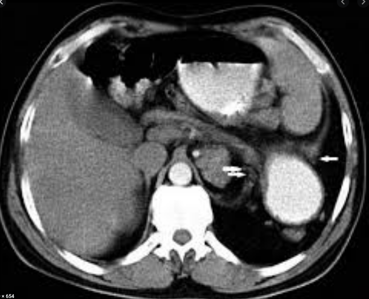 delayed diaphragmatic hernia on CT imaging
