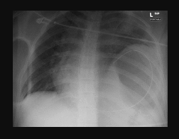 CXR showing a nasogastric tube noted to terminate in the left chest cavity with a left diaphragm rupture