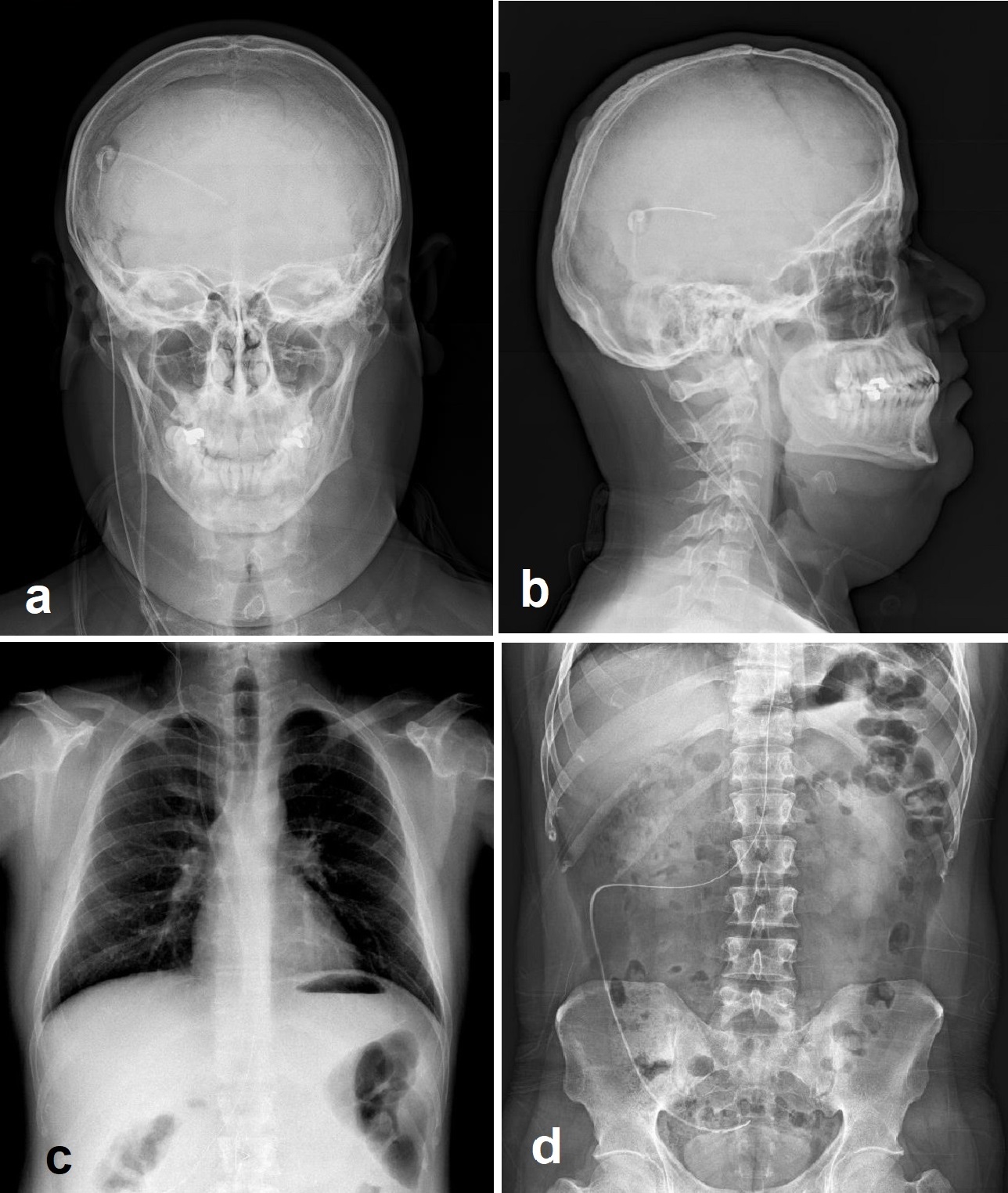 Shunt series including biplanar head (a and b), anteroposterior chest (c) and anteroposterior abdominal (d) radiographs demonstrating the ventriculoperitoneal shunt catheter throughout its course.