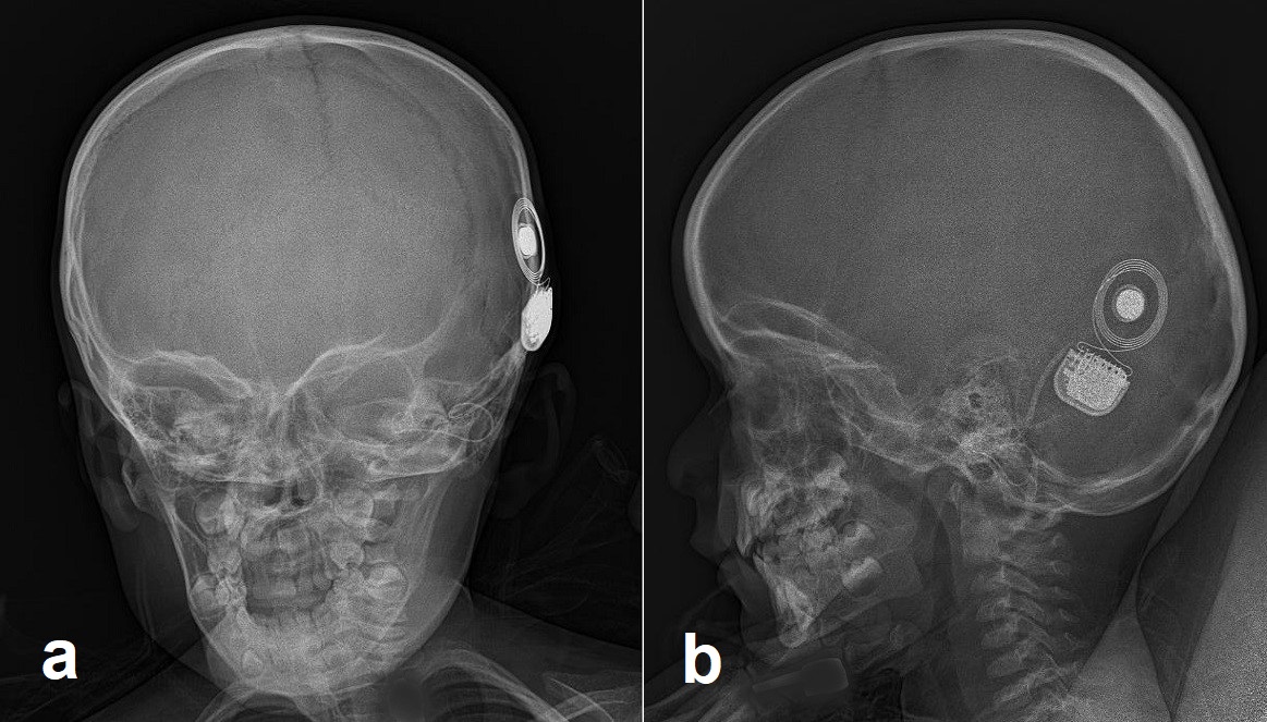 Anteroposterior (a) and lateral (b) skull radiographs showing cochlear implant components within the left inner ear and on the left temporal bone.