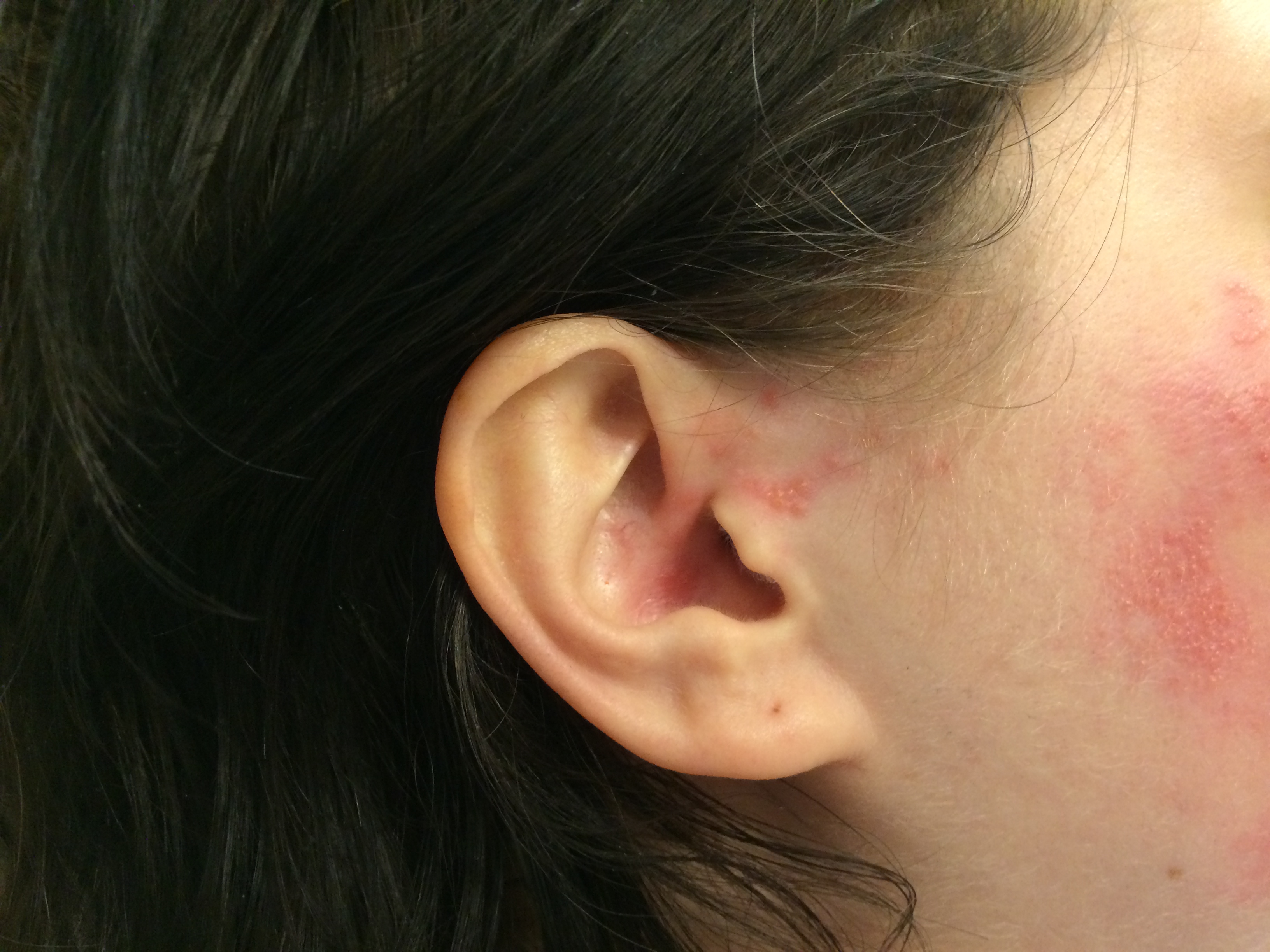 vesicular rash extending to the auricle with facial droop from Ramsay Hunt Syndrome