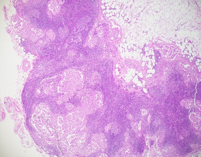 Hemotxylin and eosin stained slide of a lymph node showing metastatic carcinoma.
