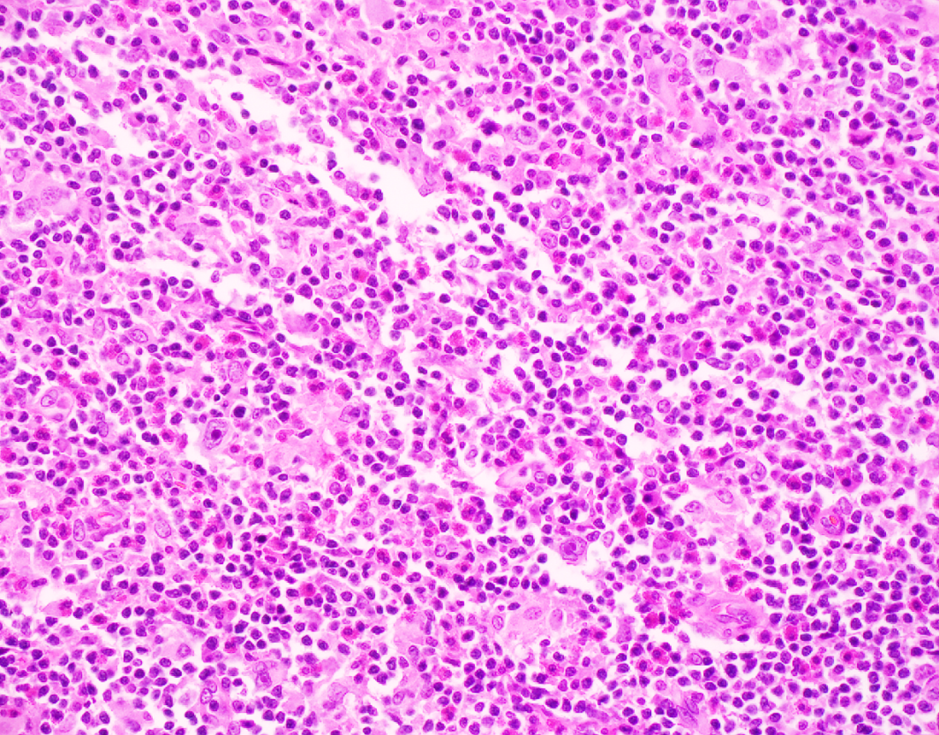 Section of lymph node with large cells with owl eye "Hodgkin cells" in a background of mixed inflammatory cells in a young male