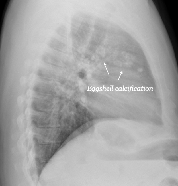 Eggshell calcification of hilar lymph nodes highly suggestive of silicosis