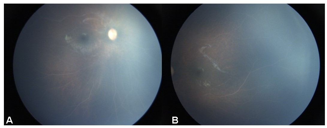 Figure 1 : Fundus photo of right eye ( Figure 1, A ) and left eye ( Figure 2, B ) of a 15 month old male child showing whitish creamy retinal vessels suggestive of lipemia retinalis. The child was born at 32 weeks  and had a birth weight of 1100 grams. The child was referred by the paediatrician for screening of retinopathy of prematurity. However, the parents delayed the presentation of the child to the ophthalmologist. The parents were counselled in the ophthalmology clinic about the need of laboratory evaluation of lipid profile and the child was referred back to the paediatrician. 