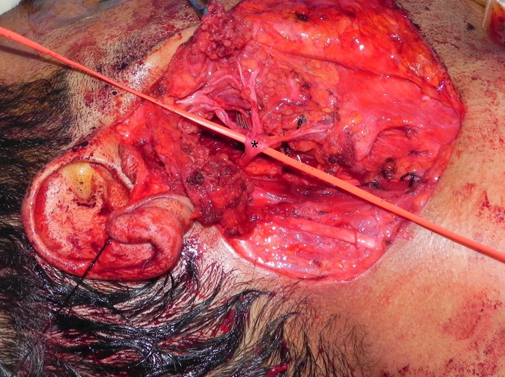Total parotodectomy, main trunk of the facial nerve and its branches dissected free from the deep lobe before the excision of the latter. Asterisk on the Pes Anserinus.