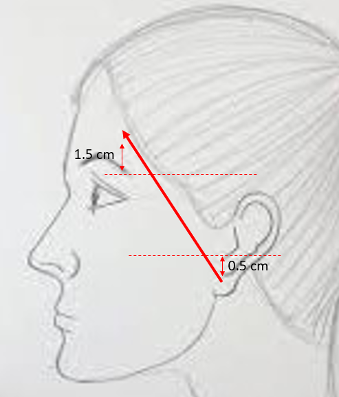 The course of the temporal branch can be predicted using surface landmarks as described elegantly by Pitanguy et al: A line starting from a point 0.5 cm below the tragus in the direction of the eyebrow, passing 1.5 cm above the lateral extremity of the eyebrow 