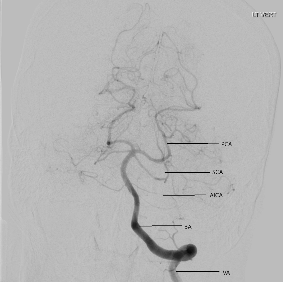 Digital Subtraction Angiogram of the left vertebral artery