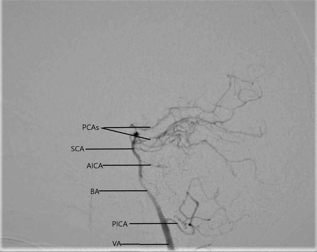 Digital subtraction angiogram in lateral view of the left vertebral artery
