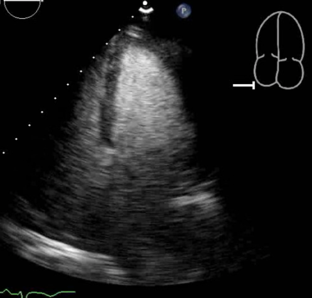 Mid-Ventricular Cardiomyopathy.

The picture shows the Left Ventricle in Diastole.