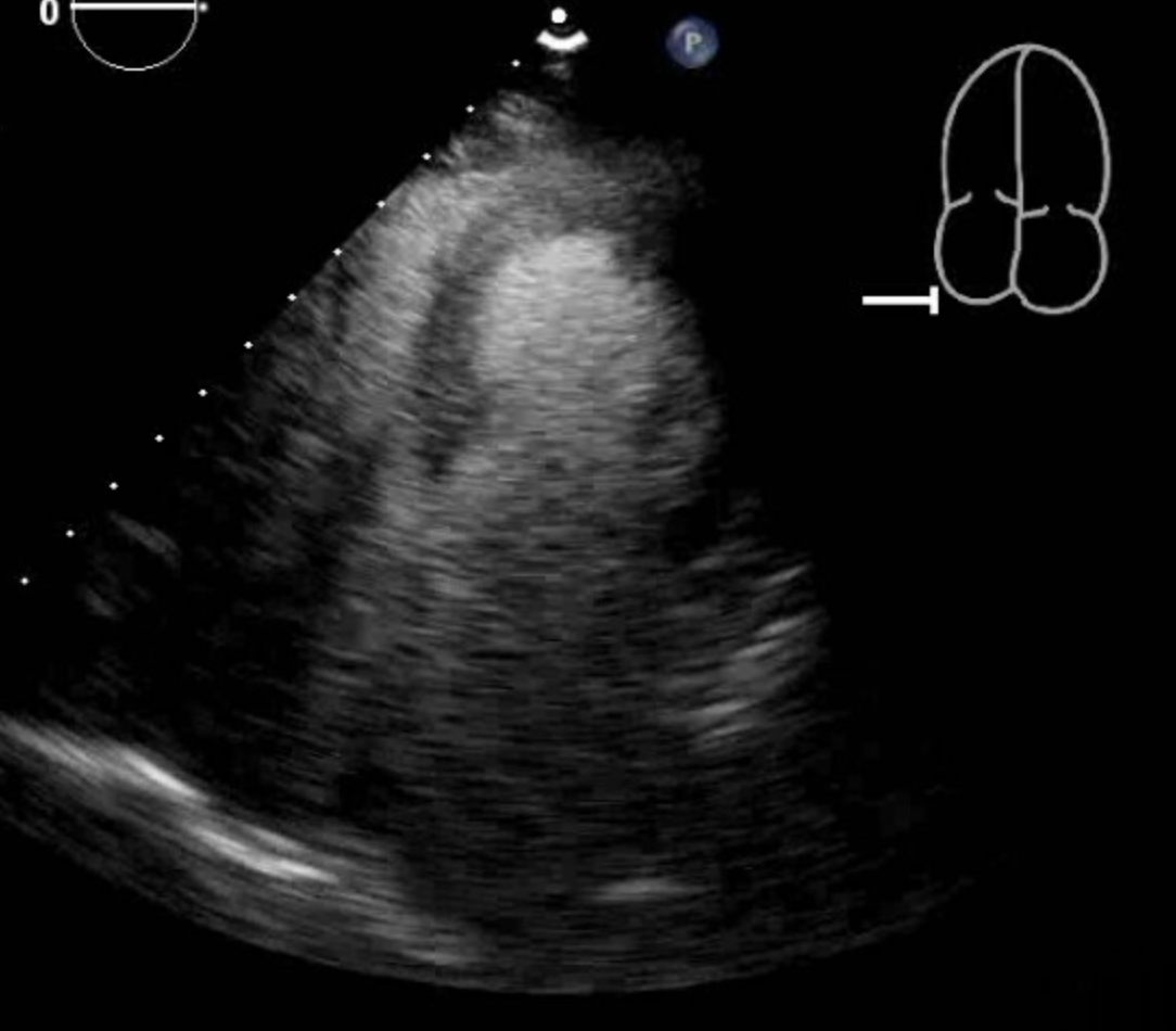 Mid-Ventricular Cardiomyopathy The picture shows the Left Ventricle in Systole with mid ventricular dilation.