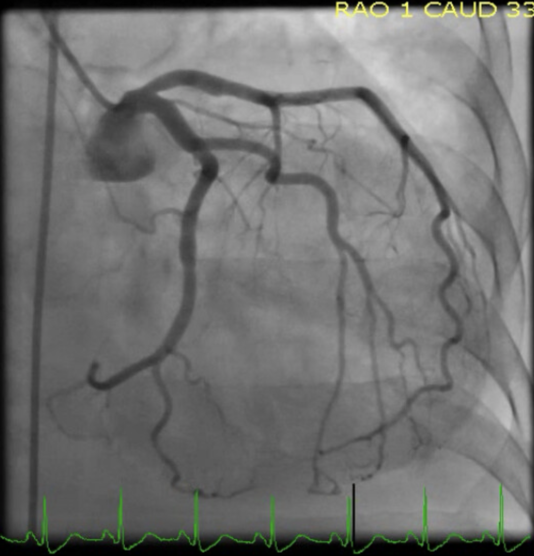 Mid-Ventricular Cardiomyopathy

Left Heart Catheterization showing normal coronaries in the patient with shown transthoracic echocardiographic findings.