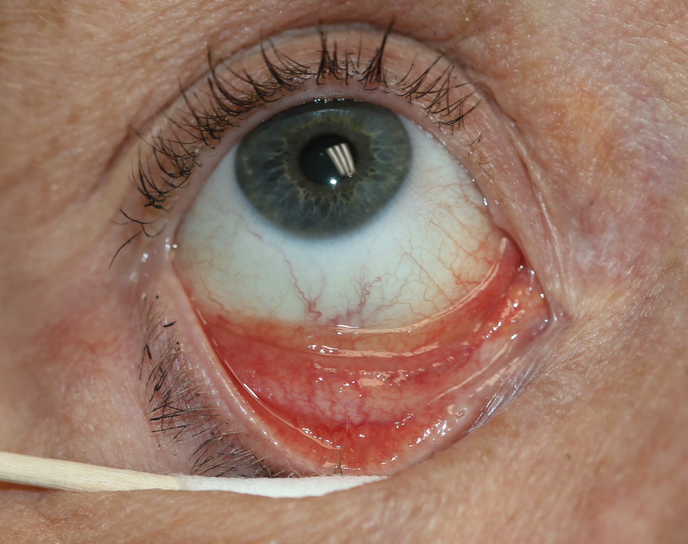 Follicular conjunctivitis may be seen with viral infections like herpes zoster, Epstein-Barr virus infection, infectious mononucleosis), chlamydial infections, and in reaction of topical medications and molluscum contagiosum. Follicular conjunctivitis has been described in patients with the Clovid-19 infection (coronavirus infection). The inferior and superior tarsal conjunctiva and the fornices show gray-white elevated swellings which are about 105 - 1 mm in diameter and have a velvety appearance