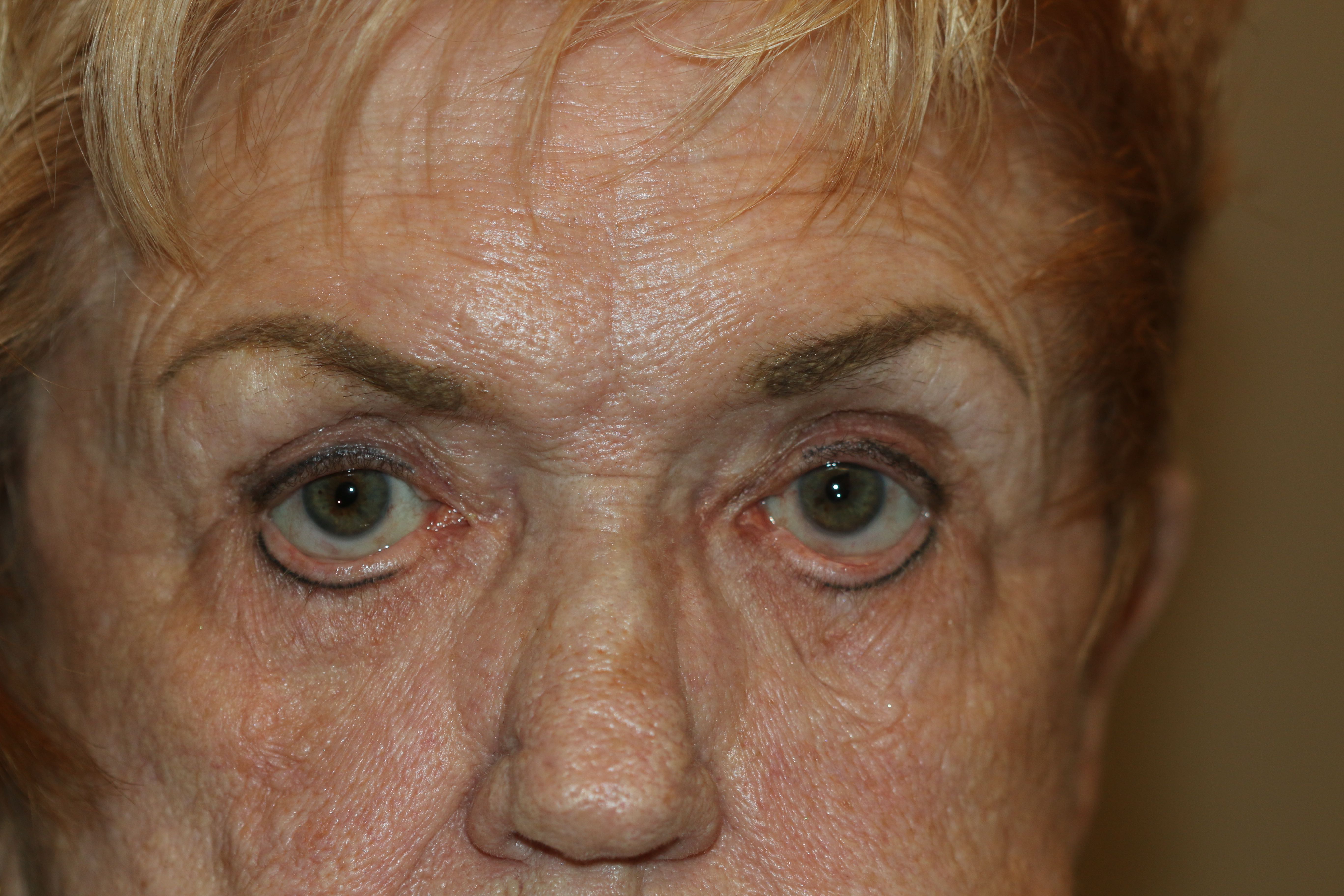 Lower Eyelid Laxity: patient presents with tearing but also dryness