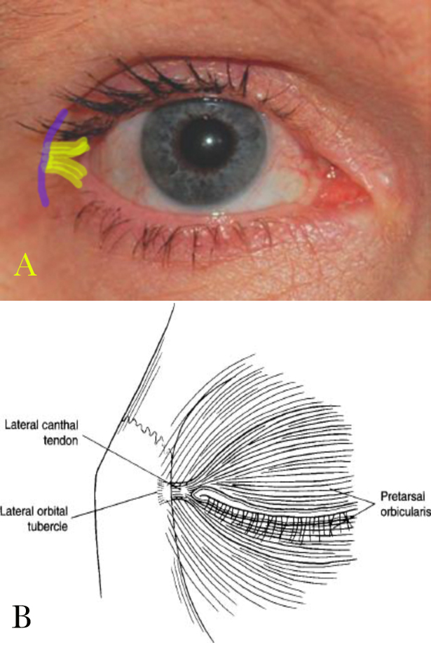 Lower eyelid Anatomy: anatomy of the lateral canthal tendon
