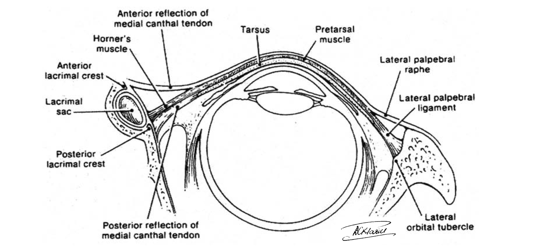 Lower Eyelid Cross-sectional anatomy: the medial canthal tendon has an anterior reflection with inserts to the anterior lacrimal crest and a posterior limb which attaches to the posterior lacrimal crest