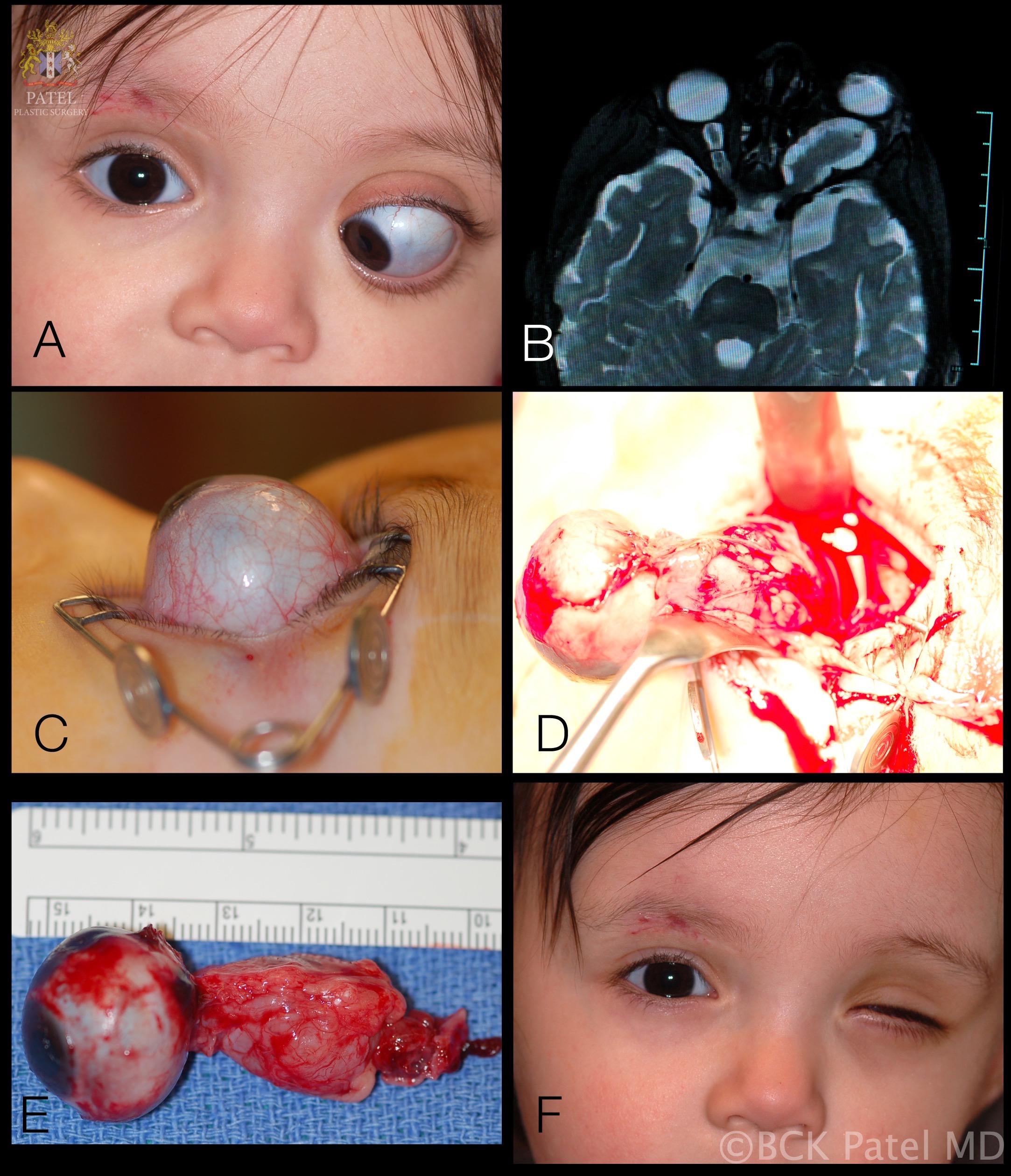 Left optic nerve glioma. A: 12-month-old female presents with marked proptosis, esotropia and lagophthalmos. There was total optic atrophy with a left afferent pupillary defect. B: Axial T2-weighted MRI shows the left optic nerve tumor with the typical kink that is often seen in these large tumors. C: The severity of proptosis is visible on the lateral view where most of the globe is prolapsed out of the orbit. D: Peroperative view of removal of the eye and the tumor. E: Gross specimen. F: Appearance one month after surgery. A prosthetic eye is awaited. 