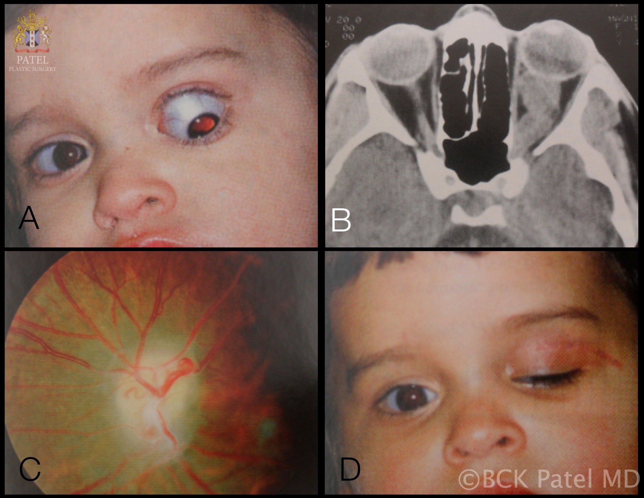 Optic nerve glioma. A: 16-month-old male with presents with marked proptosis, hypoglobus, hypotropia, afferent pupillary defect and optic atrophy. B: CT scan shows a large left optic nerve tumor with a midpoint kink that is often seen. Enlargement of the optic canal and enlargement of the sella turcica (Turk's saddle). C: Optic atrophy D: One month after combined neurosurgical and orbital surgery to remove the tumor with preservation of the globe.