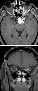 Optic nerve sheath meningioma: "Tram-track" sign seen in the upper axial contrast-enhanced MRI in a patient with optic nerve sheath meningioma. The thickened optic nerve sheath enhances showing the tram-track appearance. Lower coronal MRI shows the "bull's eye" appearance of the optic nerve with a hyperintense ring, again because of the thickened enhancing optic nerve sheath meningioma