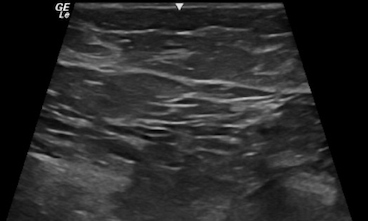 Sonographic cross-sectional view of benign breast tissue with typical hyperechoic, hypoechoic layers of skin, fat, fibroglandular and muscle.