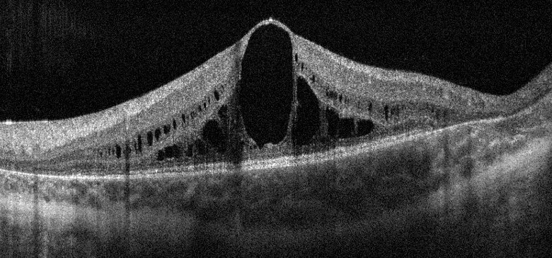 Optical coherence tomography of the macula showing intraretinal cystic spaces in a 12-year-old boy with gyrate atrophy of the choroid and retina.