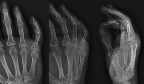 AP, lateral, and oblique xray images of a right small finger proximal phalanx fracture