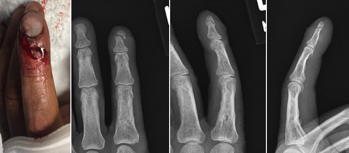 Distal phalanx fracture of the left index finger: gross image with AP, oblique, and lateral xrays.