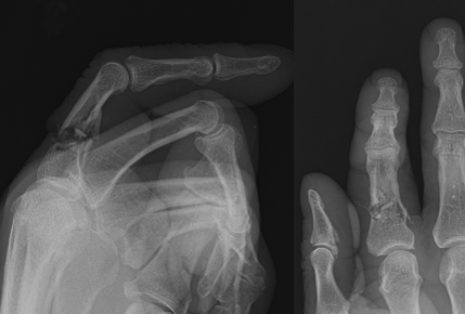Proximal phalanx fracture of right index finger - lateral and AP radiographs