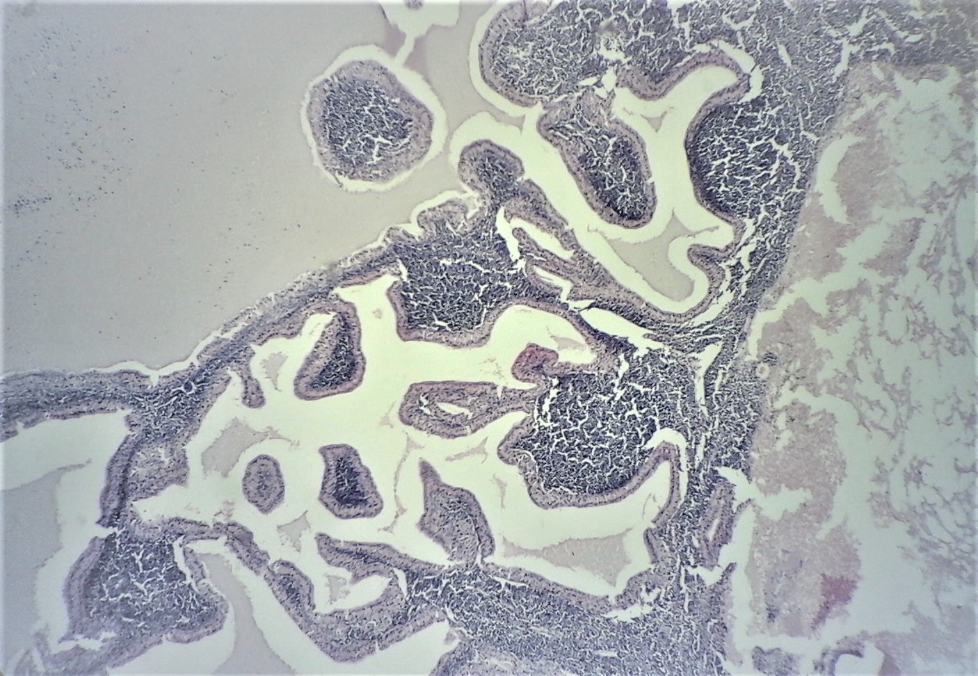 Figure 1:
Warthin tumor composed of glandular, cystic and papillary structures lined by oncocytic epithelial cells. There is a dense population of lymphocytes in the stroma, (Hematoxylin and eosin, x 40).
