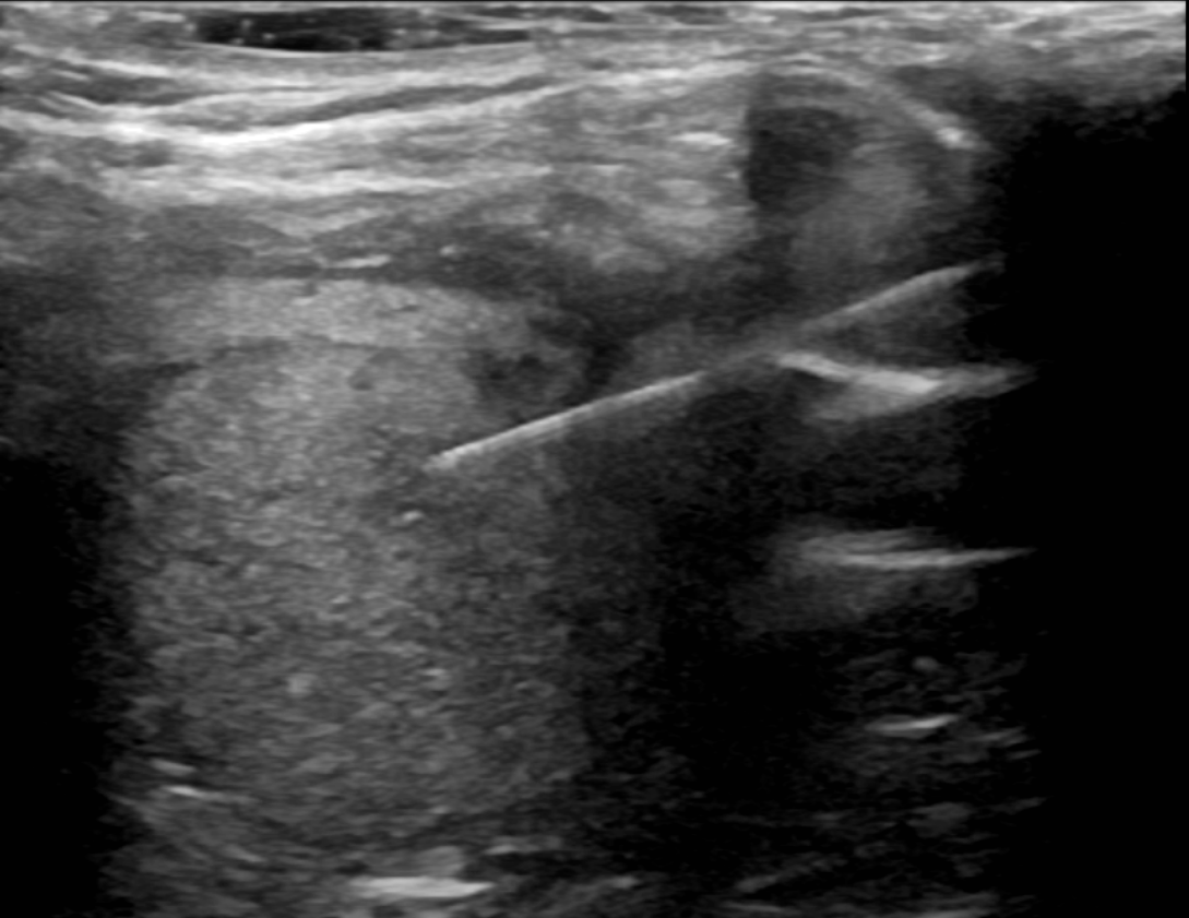 Figure 1: An isoechoic nodule is appreciated within the left thyroid lobe. A thin linear echogenic needle is seen terminating within the thyroid nodule.