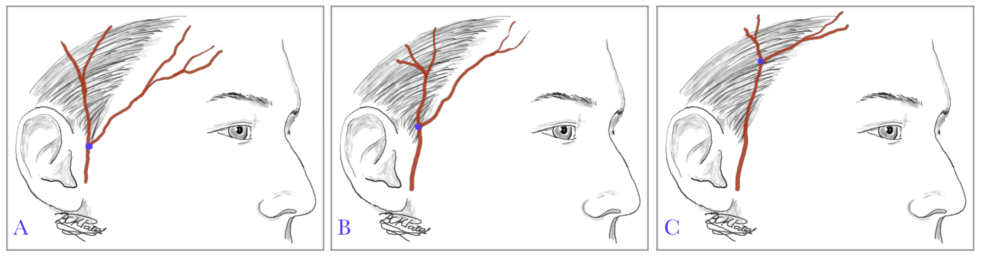 Superficial Temporal Artery: points of bifurcation