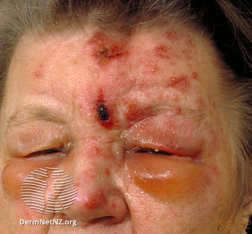Herpes Zoster Ophthalmicus with Hutchinson sign