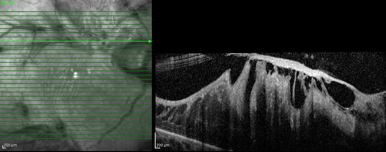 Optical coherence tomography (OCT) of proliferative diabetic retinopathy with tractional retinal detachment in the right eye