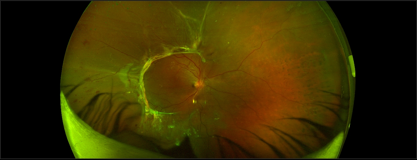 Proliferative diabetic retinopathy with extramacular tractional retinal detachment