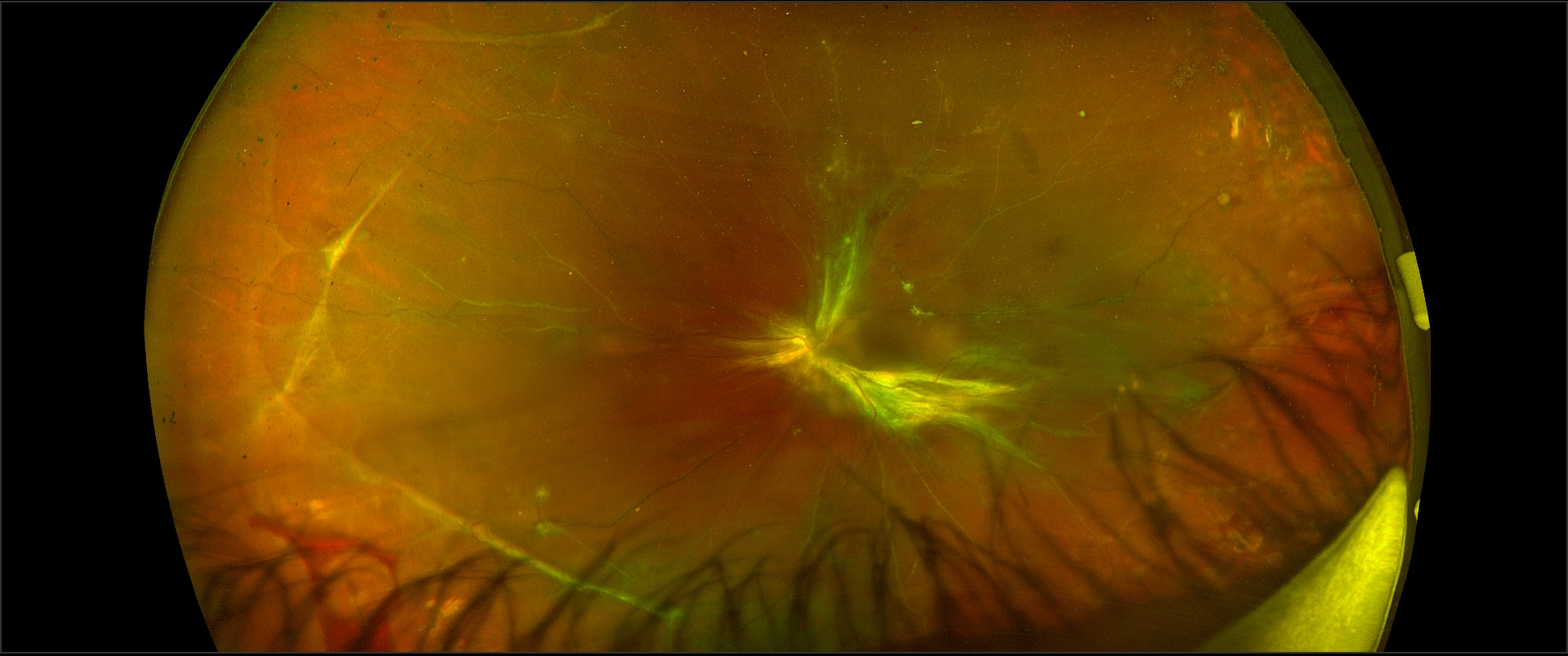 Proliferative diabetic retinopathy with macular traction retinal detachment in the left eye