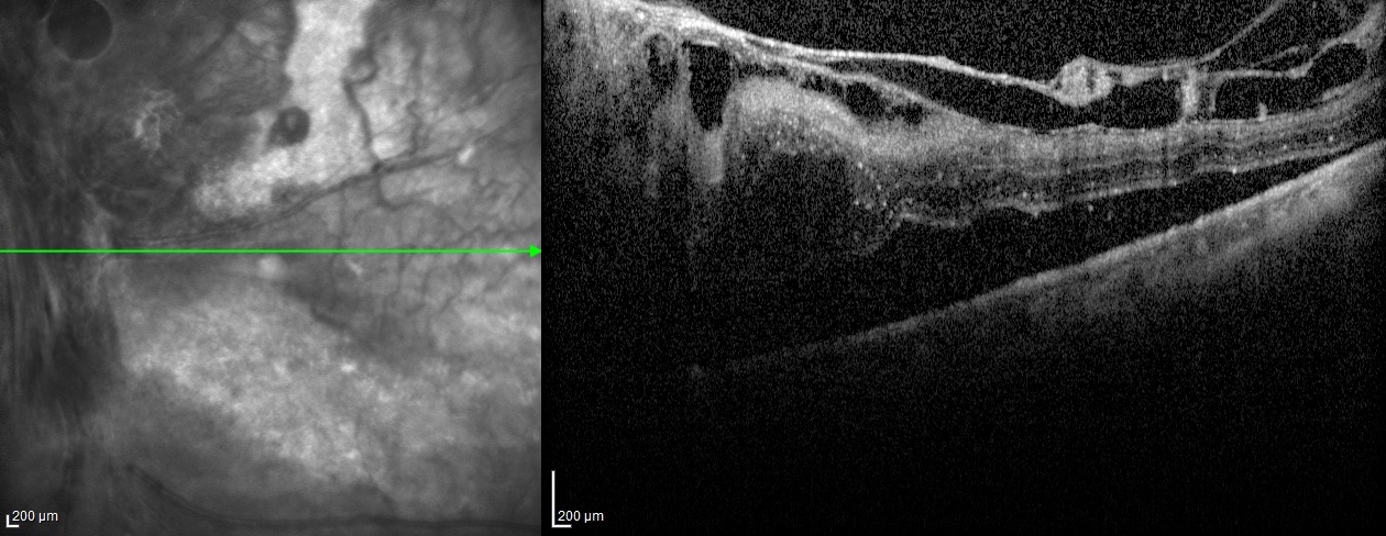Optical coherence tomography (OCT) scan of macula of the left eye showing macular traction retinal detachment due to proliferative diabetic retinopathy (PDR) 