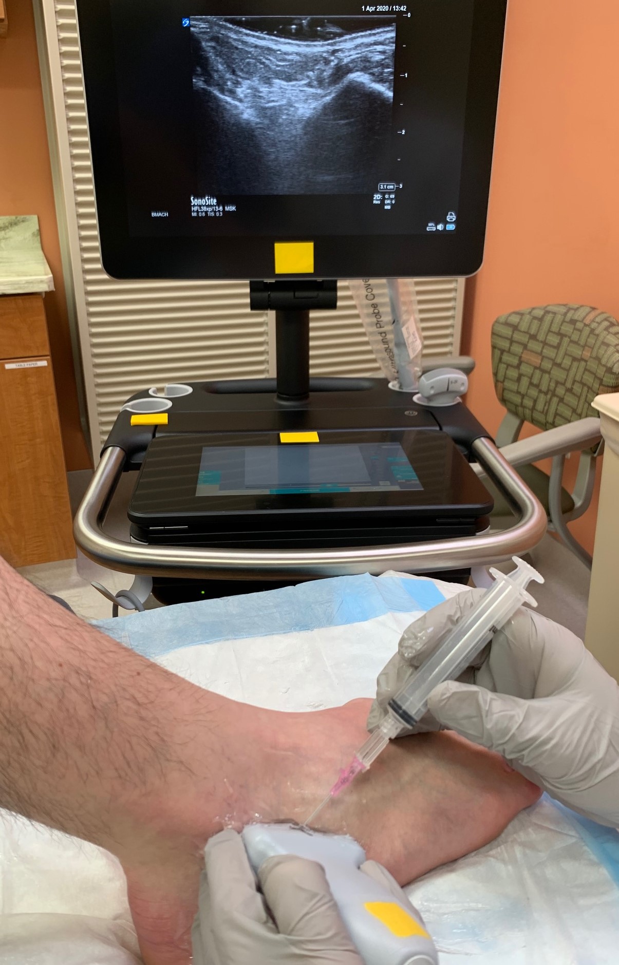 Demonstration of positioning and location for access to subtalar ankle joint with ultrasound guidance.  Ultrasound monitor demonstrates desired landmarks of Talus (left) and Calcaneus (right).