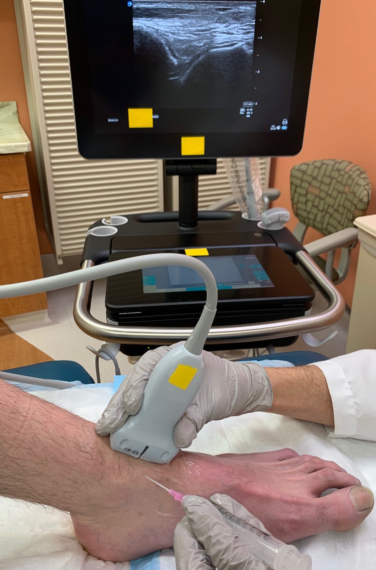 Demonstration of positioning and location for access to tibiotalar ankle joint with ultrasound guidance.  Ultrasound monitor shows desired landmarks of tibia (left) and talus (right).