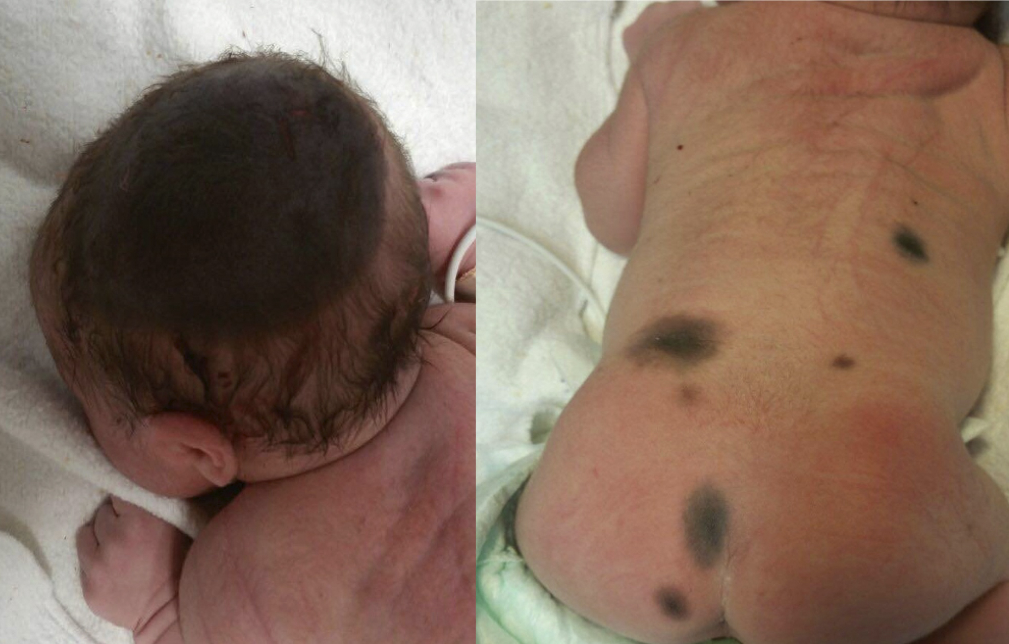 Giant congenital melanocytic nevus in a newborn (left) with satellite lesions on the patient's back and buttocks (right)