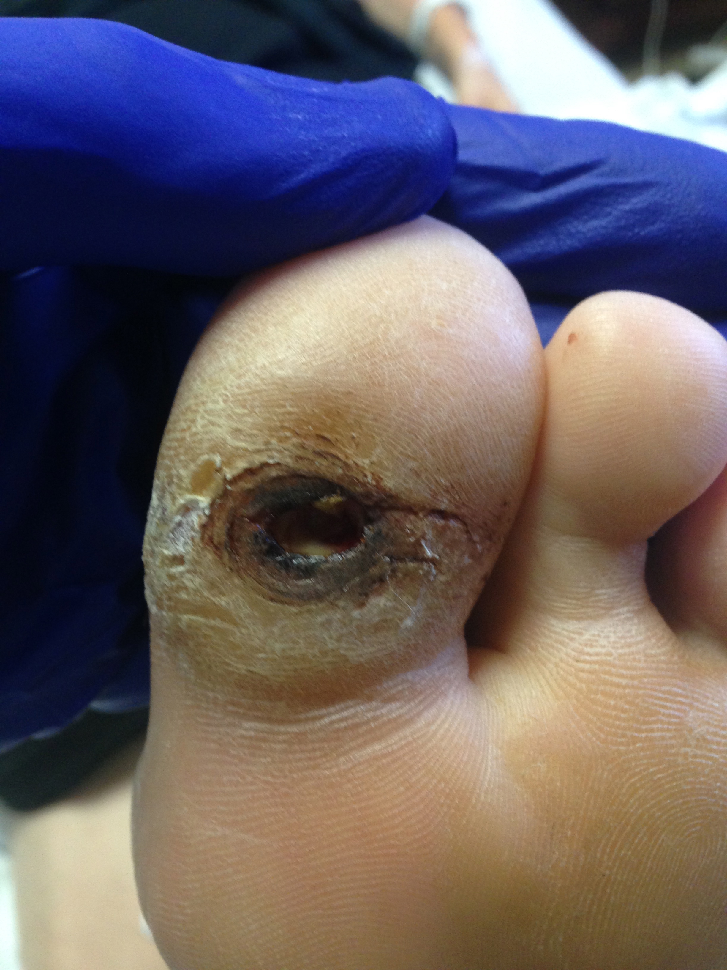 Neuropathic Ulcer
Located beneath great toe in a patient with diabetes and peripheral neuropathy.