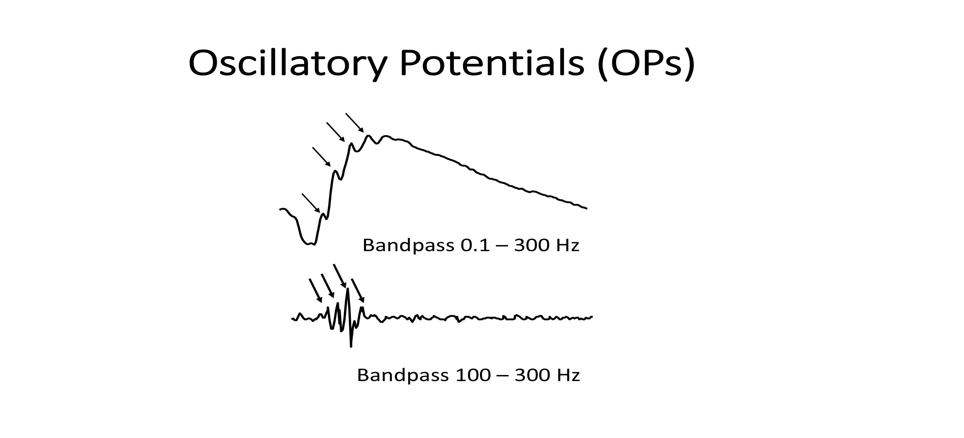 Illustration of oscillatory potentials (arrows) isolated by changing the bandpass filter used for recording the ERG