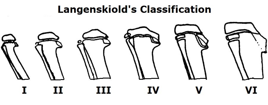 Langenskiold's Classification