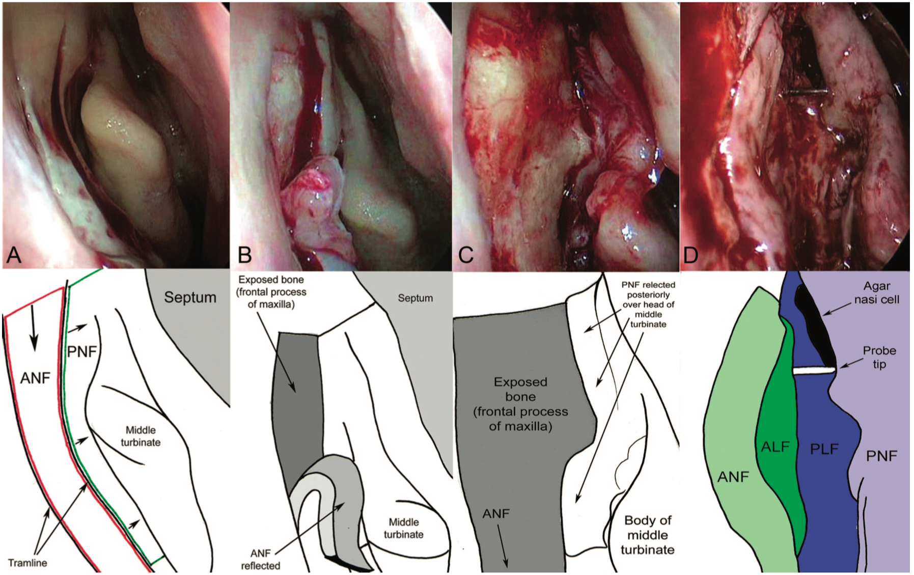 Creation of Mucosal Flaps in an Endoscopic Dacryocytorhinostomy: The right nasal cavity. A mucosal incision with a small angled crescent blade is made on the lateral nasal wall, 8 mm above the insertion of the middle turbinate extending down to just below the body of the middle turbinate. A parallel vertical incision made 8 mm anterior to this creates the tramline. A superior incision joining the 2 lines completes the anterior nasal flap (A). The flap is blunt dissected off bone and reflected inferiorly (B). Following reflection of the posterior nasal flap the maxillary bone is more widely exposed (C). Following lacrimal sac marsupialization, all 4 flaps are positioned with edge-to-edge apposition. The probe is seen in between the lacrimal flaps (D). We gratefully acknowledge the work of Francois Codere and Peter J. Wormald in the development of this novel flap design. ANF, anterior nasal flap; PNF, posterior nasal flap; ALF, anterior lacrimal flap; PLF, posterior lacrimal flap.